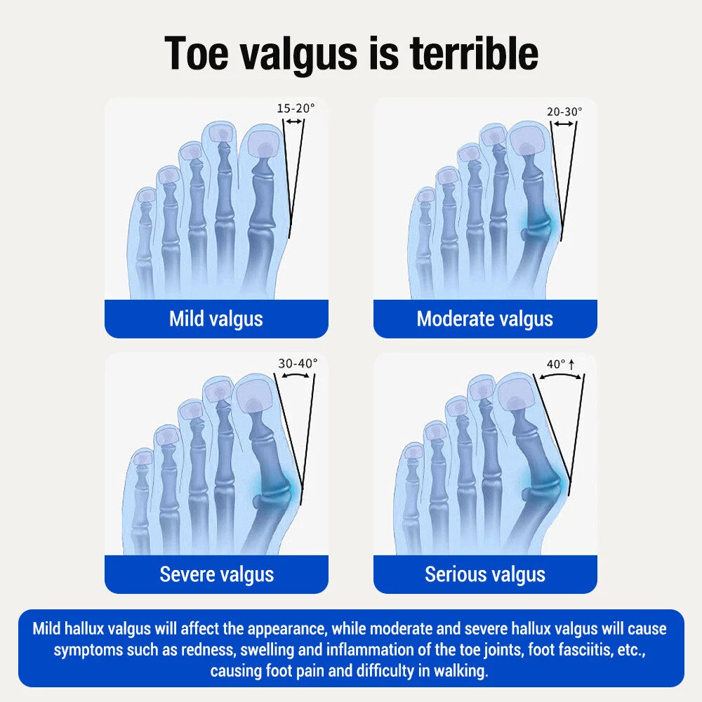 Toe Valgus Corrector – Adjustable Toe Alignment & Support